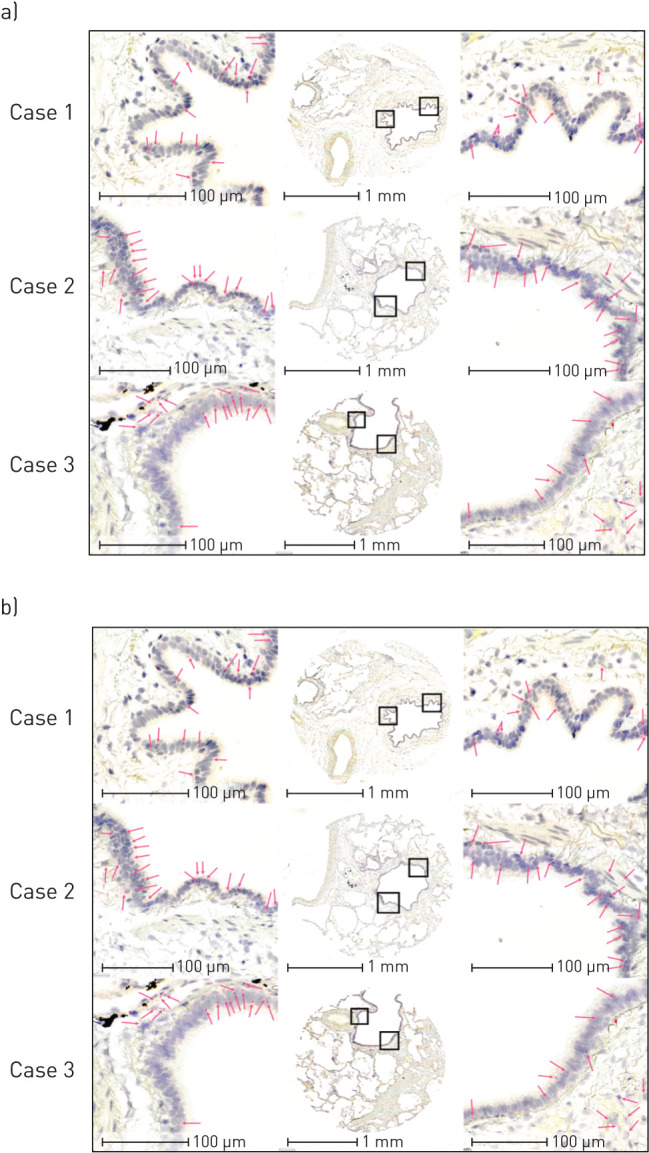 In situ hybridisation detection of CNR1 and CNR2 gene transcripts in human airway epithelial cells. In situ hybridisation of a) CNR1 and b) CNR2 in three patient donors representative of n=10. Serial sections of each of the three cases were stained for CNR1 and CNR2. Low magnification images are in the centre of a and b, with high-powered magnification regions of interest on either side highlighted by black boxes. Pink arrows correspond to positive puncta representative of mRNA transcript.