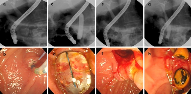 Endoscopic papillary large balloon dilatation (EPLBD) procedure. a Cholangiogram shows a large dilated common bile duct (CBD) and multiple bile duct stones. b Endoscopic sphincterotomy is performed. c, d Papillary dilation with a 20-mm large balloon. e–g Large bile duct stones were removed without crushing, by balloon retrieval and Dormia basket. h Large biliary orifice after the procedure
