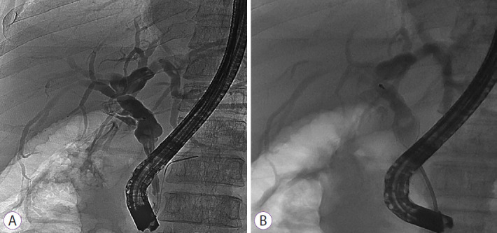 Mechanical lithotripsy for a difficult bile duct stone. (A) A 1-cm stone proximal to a considerably tapered bile duct. (B) Mechanical lithotripsy was successfully performed using a through-the-scope mechanical lithotripter, and stone clearance was achieved.
