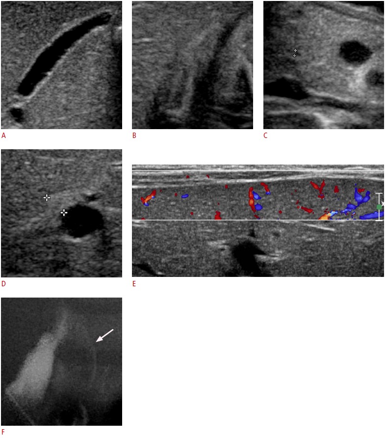 A 27-day-old boy with visible common bile duct (CBD) on ultrasonography (US) (group A).A. Mucosa, wall, and outer margin of the gallbladder look normal. Gallbladder length was measured about 20.3 mm. B. After an oral feeding, the gallbladder contracts. C. CBD is visible, and its diameter is being measured (crosshairs). D. Triangular cord thickness is 3.4 mm (crosshairs), which is less than the cut-off value of 4 mm. E. Hepatic subcapsular flow is evident on the color Doppler US. F. Operative cholangiogram shows patent CBD (arrow) without the filling of the common hepatic duct, confirming type IIIa biliary atresia.
