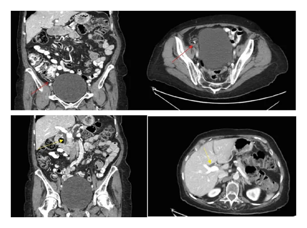 Computed tomography (coronal and axial views demonstrating clip location and CBD) 3 days after admission showing CBD dilation to approximately 10 mm (yellow arrows); previous intrahepatic bile duct distention is essentially resolved. The previously seen surgical clip in the region of the distal common bile duct is no longer evident, and there is a new clip in the region of the cecum (red arrows), presumably the migrated clip.