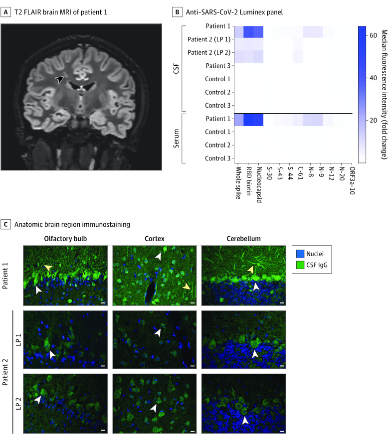 Anti–SARS-CoV-2 and Autoantibody ProfilingA, Coronal 3-dimensional cube T2-weighted fluid-attenuated inversion recovery (FLAIR) brain magnetic resonance imaging (MRI) of patient 1. A linear hyperintense lesion in the right frontal centrum semiovale is noted (arrowhead). B, Cerebrospinal fluid (CSF) and sera from patients and controls were screened for anti–SARS-CoV-2 antibodies on a Luminex platform encoding whole-spike and nucleocapsid proteins, the spike receptor-binding domain (RBD), and spike, nucleocapsid, and ORF3a peptide antigens. The heatmap values represent the fold change of the median fluorescence intensity of averaged technical replicates for each biospecimen relative to negative controls. C, Select anatomic regions immunostained by patient 1’s CSF and CSF from patient 2’s first and second lumbar punctures (LPs) at a 1:4 dilution. White arrowheads in the olfactory bulb, cortex, and cerebellum indicate immunostained mitral cells, cortical neurons, and Purkinje cells, respectively. Yellow arrowheads indicate neuronal processes. Scale bars are 10 μM. IgG indicates immunoglobulin G.