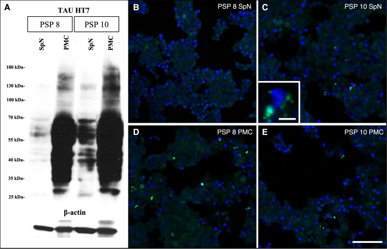 Tau immunoblot analysis and in vitro tau seeding assay. (A) Tau immunoblot, total tau (HT7 clone), reveals the presence of tau in all four samples. (B–E) In vitro tau biosensor cells demonstrate that tau deposits (green) in the primary motor cortex (D and E) and cervical spinal nerve (C, enlarged image in the bottom left corner) samples have seeding capacity. (B and D) PSP Case 8 (PSP 8) and (C and E) PSP Case 10 (PSP 10). PMC = primary motor cortex; SpN = spinal nerves. Scale bars in B–E = 100 μm and C, enlarged image in the bottom left corner = 10 μm.
