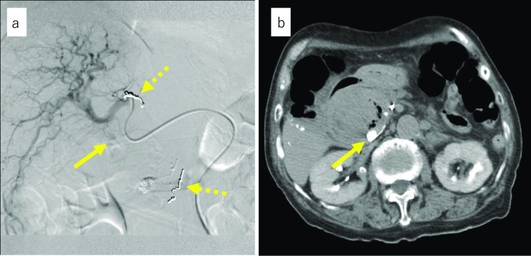 Findings from angiography performed in our hospital. a Contrast image of the proper hepatic artery is shown. The inferior pancreaticoduodenal artery and branch of the proper hepatic artery were coiled at a previous hospital (dotted arrow). A solid arrow shows extravasation. The culprit vessel was suspected to be the PBP, which is a branch of the proper hepatic artery. b Transverse CT image after embolization with lipiodol and n-butyl-2-cyanoacrylate is shown. An arrow shows embolized pseudoaneurysm