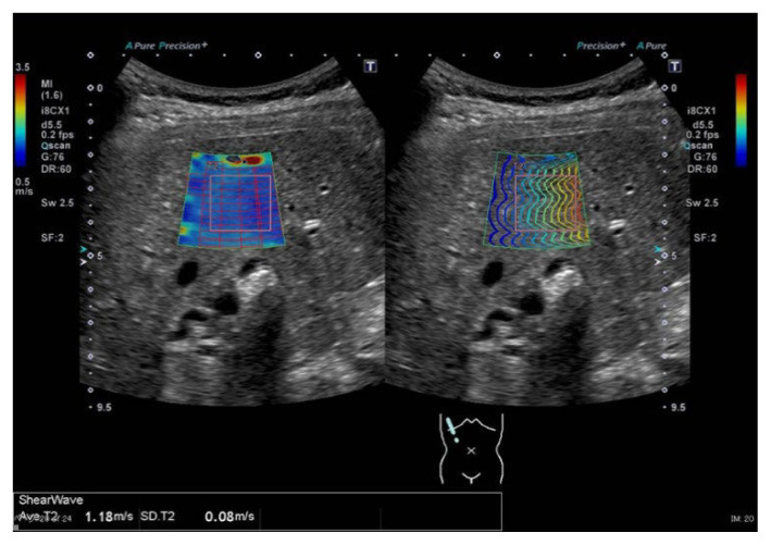 Measurement of liver stiffness using shear wave elastography