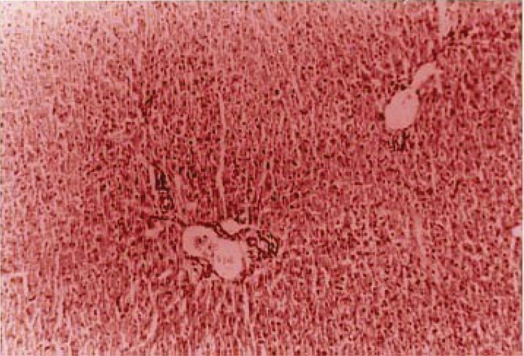 Portal area sinusoidal and vascular congestion, associated to hepatocellular bile stasis in the liver tissue.