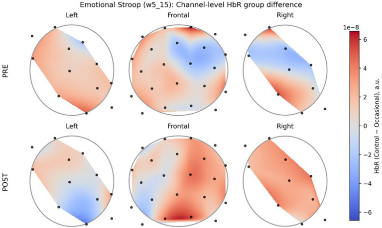 Six circular topographic brain maps display channel-level hemodynamic response (HbR) group differences for an emotional Stroop task, separated by PRE and POST rows and Left, Frontal, and Right columns. Red indicates greater HbR difference in controls, blue in occasional users, with a colorbar on the right. Black dots represent channel positions.