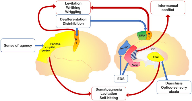 Relevant brain areas associated with alien hand–alien limb (AH-AL) variants and motor control. In yellow, the parieto-occipital and thalamic regions, which are damaged in posterior variant; in dark blue, the medial prefrontal cortex, impaired in the frontal variant; in light blue, the corpus callosum, whose anterior region is involved into the callosal variant; in orange, the primary motor cortex, whose isolated activation has been documented in involuntary movements; in green, the supplementary motor area (SMA) involved in internal drives of motor planning; and in red, the anterior cingulate cortex, implicated in action inhibition.