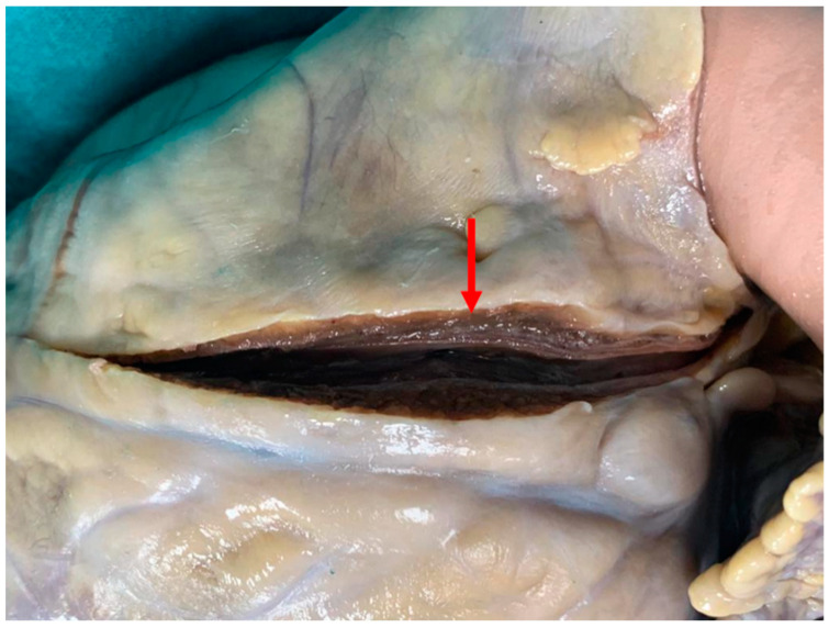 Heart after fixation, myocardial bridging: the left anterior descending coronary artery starts with a normal course, but at 2 cm from its beginning, it tunnels through the myocardium (the 0.3 cm thick, 5.5 cm long tunneled tract is indicated by the red arrow: the dark overlying myocardium bridge is clearly visible).