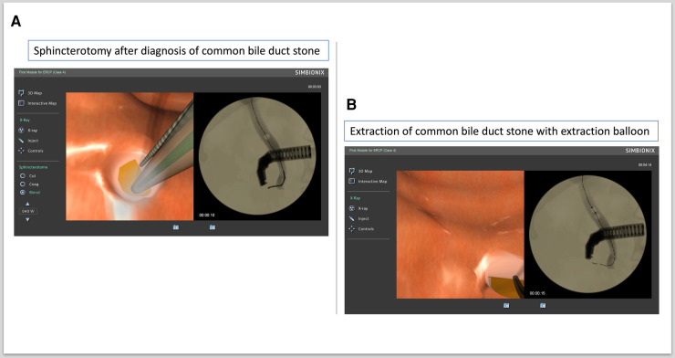 Extraction of common bile duct (CBD) stone. (A) Sphincterotomy after diagnosis of CBD stone. (B) Extraction of CBD stone with extraction balloon.