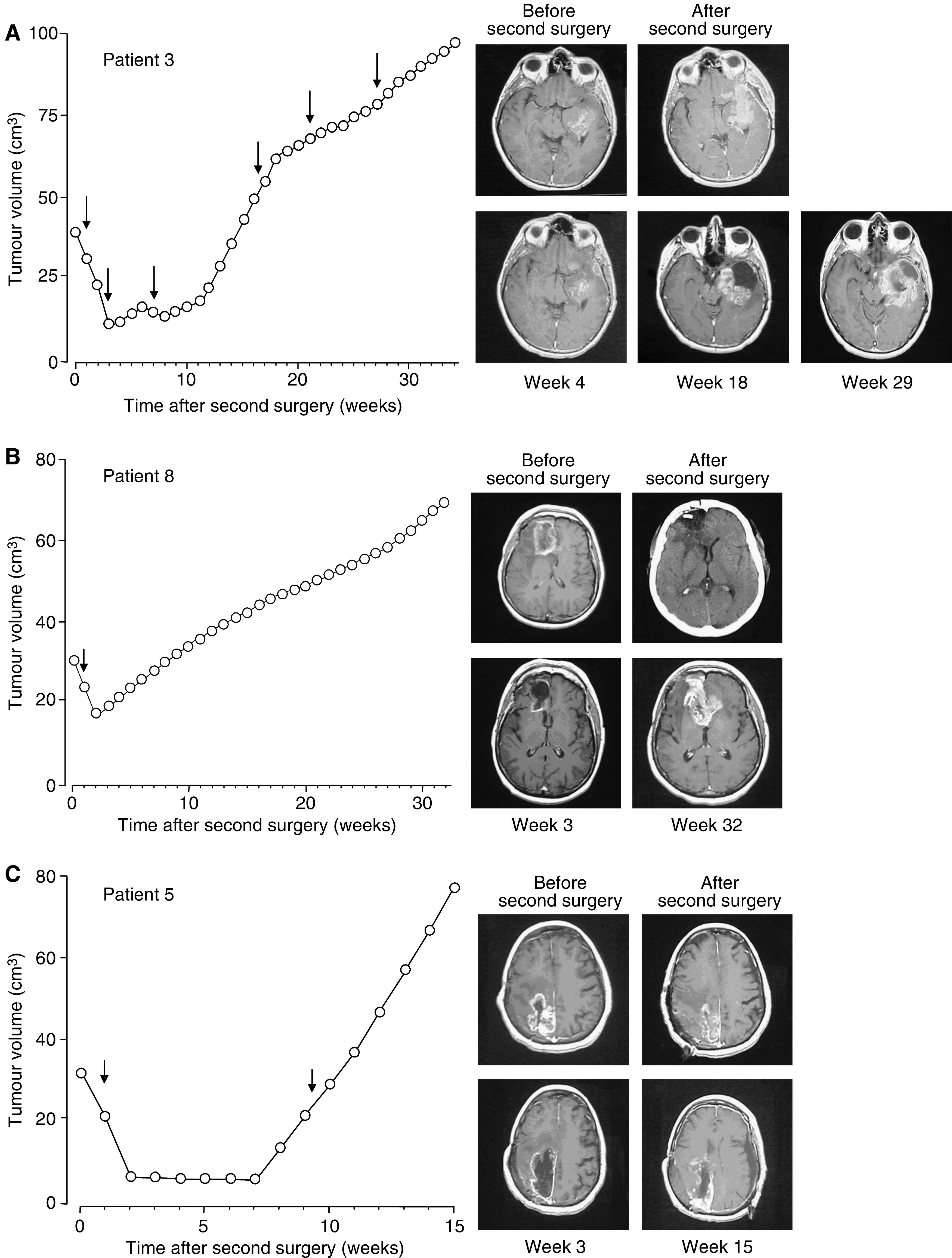 Effect of THC administration on tumour growth. Tumour growth plots and gadolinium-enhanced T1-weighted magnetic resonance scans after the second surgery in three patients. Arrows indicate the THC administration cycles. (A) Patient 3, scans before and after surgery of tumour relapse as well as after the second, fourth and sixth THC cycle (weeks 4, 18 and 29, respectively). (B) Patient 8, scans before and after surgery of tumour relapse as well as after the THC cycle (week 3) and at week 32. (C) Patient 5, scans before and after surgery of tumour relapse as well as after the fist THC cycle (week 3) and at week 15.