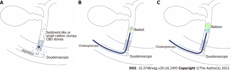 The sketch map of cholangioscopy-assisted extraction through novel papillary support for small-calibre and sediment-like common bile duct stones. A: The sketch map of cholangioscopy-assisted aspiration extraction through the support for small-calibre or sediment-like common bile duct (CBD) stones; B: The sketch map of cholangioscopy-assisted basket extraction through the support for small-calibre CBD stones; C: The sketch map of cholangioscopy-assisted balloon extraction through the support for multiple small-calibre CBD stones.