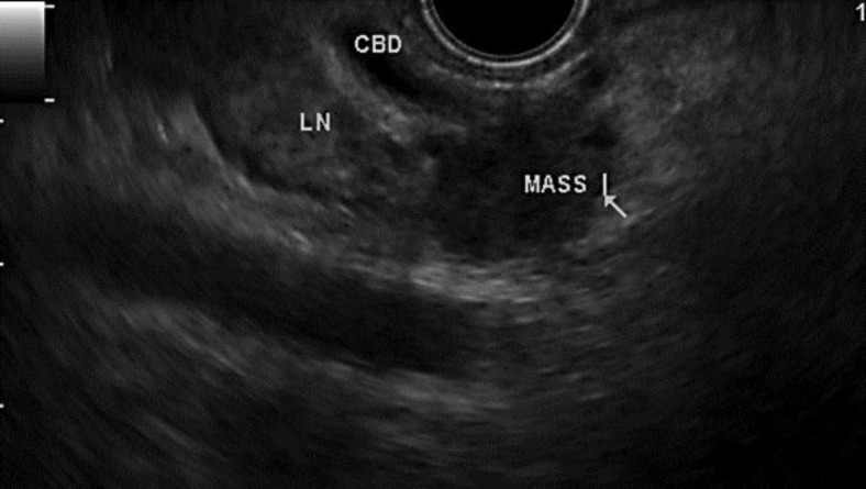 EUS demonstrated a mass in the CBD with adjacent lymphadenopathy and dilated CBD. LN = Lymph node.