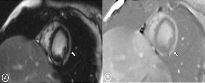 Short-axis 2-chamber PSIR sequence (Mid Cavity)- A MAG; B PHASE images—showing patchy delayed gadolinium enhancement of subepicardial in multiple segments of cardiac mid cavity