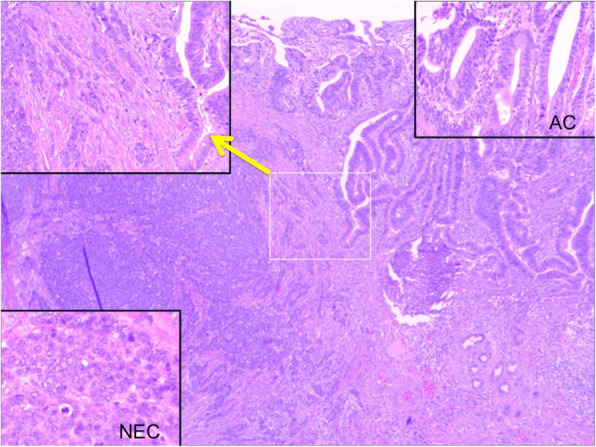 Microscopically, the tumor was composed of predominantly well-differentiated tubular AC in the superficial layer, admixed with NEC in the deeper portion, indicating MANEC of the DBD (arrow; transitional area)