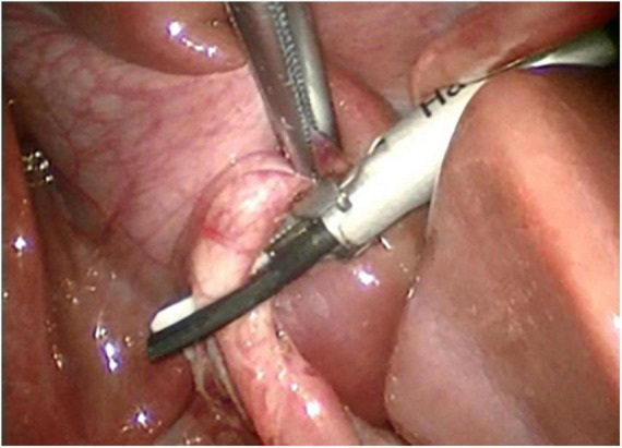 Cutting of cystic duct with harmonic shear.