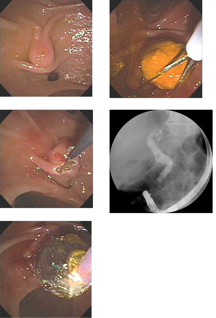 Side viewing endoscope. (A) Endoscopic view of naïve papilla (B) Precutting of naïve papilla with needle knife in reverse direction (C) Endoscopic papillary balloon dilatation (D) Removal of CBD stone with basket (E) Cholangiogram showing dilated bile duct with two movable filling defects