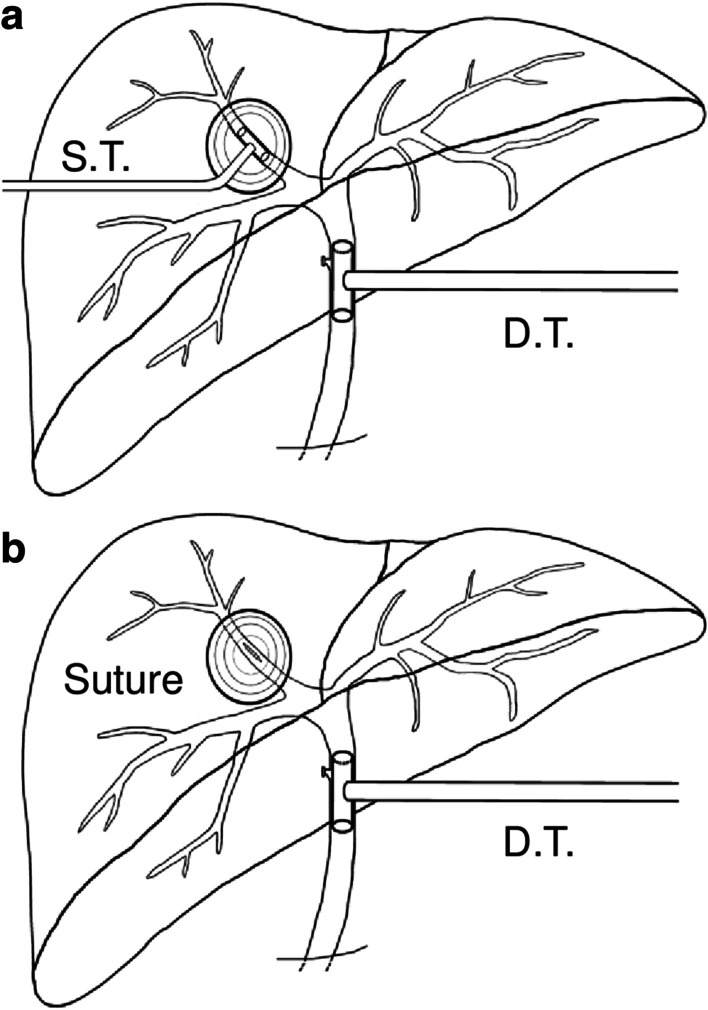Schematic diagram of different biliary surgical techniques for cysto-biliary communications. a Double T-tube drainage due to fistula; b Single T-tube drainage with sutured fistula. (D.T. = decompression T-tube at common bile duct; S.T. = sustaining T-tube at cysto-biliary communication site; Suture = suturing of the cysto-biliary communication site; Note that there were routine abdominal/cystic cavity draining catheters within these two techniques but they were omitted in order to magnify T-tubes in the figure)