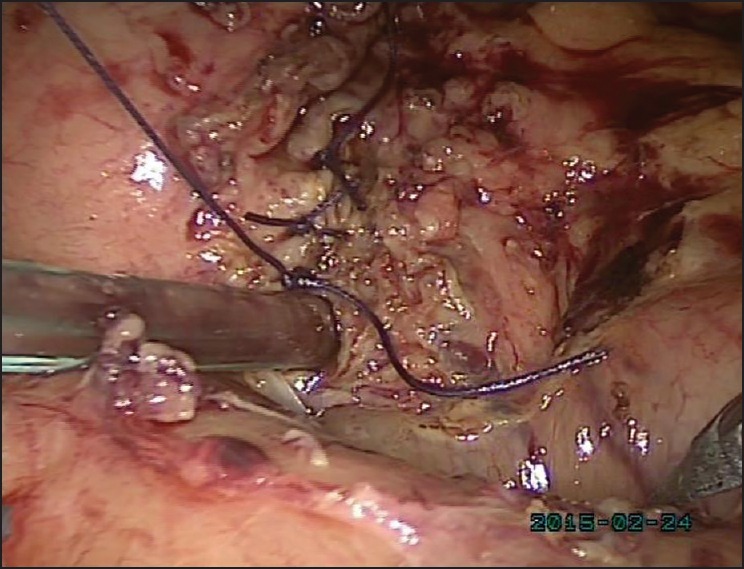 Closure of choledochotomy with Vicryl 2-0 in interrupted manner in a single layer after placement of T-tube