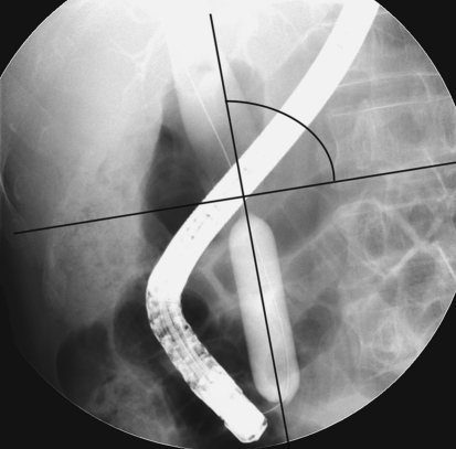 The angle of the distal common bile duct (CBD) with the horizontal plane. The angle of the distal CBD was measured as the angle between the inflated balloon at the ampulla and the horizontal plane of the vertebra (black lines)