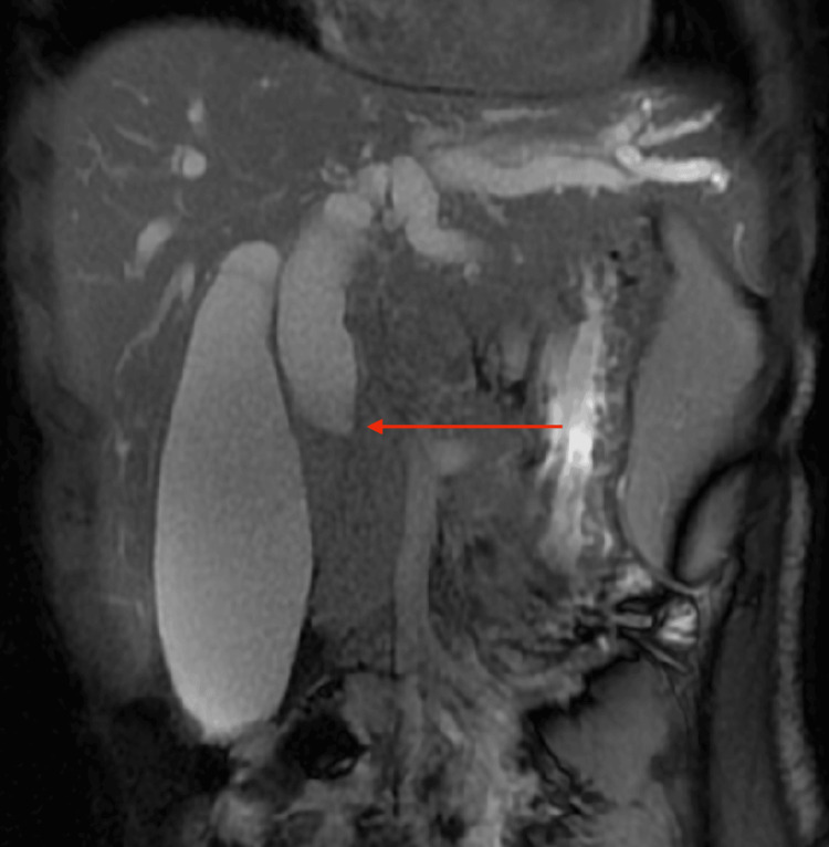 MRCP showing biliary obstruction due to a periportal lymph nodal massCoronal MRCP image demonstrates a distended gallbladder and dilated intrahepatic biliary radicals with prominence of the common bile duct proximally. There is an abrupt narrowing at the mid common bile duct (red arrow), consistent with extrinsic compression.MRCP: magnetic resonance cholangiopancreatography