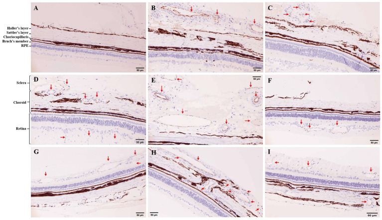 Immunohistochemistry (IHC) for CD31 in tree shrew retina and choroid (200×). (A) IHC in control group. (B,C) IHC in 7 days of photocoagulation group. (D,E,F) IHC in 14 days of photocoagulation group. (G,H,I) IHC in 21 days of photocoagulation group. The red arrow indicates neovascularization. RPE, Retinal pigment epithelium.