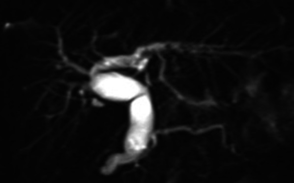 Preoperative magnetic resonance cholangiopancreatography (MRCP). MRCP showing dilatation of bile duct from the left and right intrahepatic bile ducts to the common bile duct. The gallbladder is not detected on MRCP