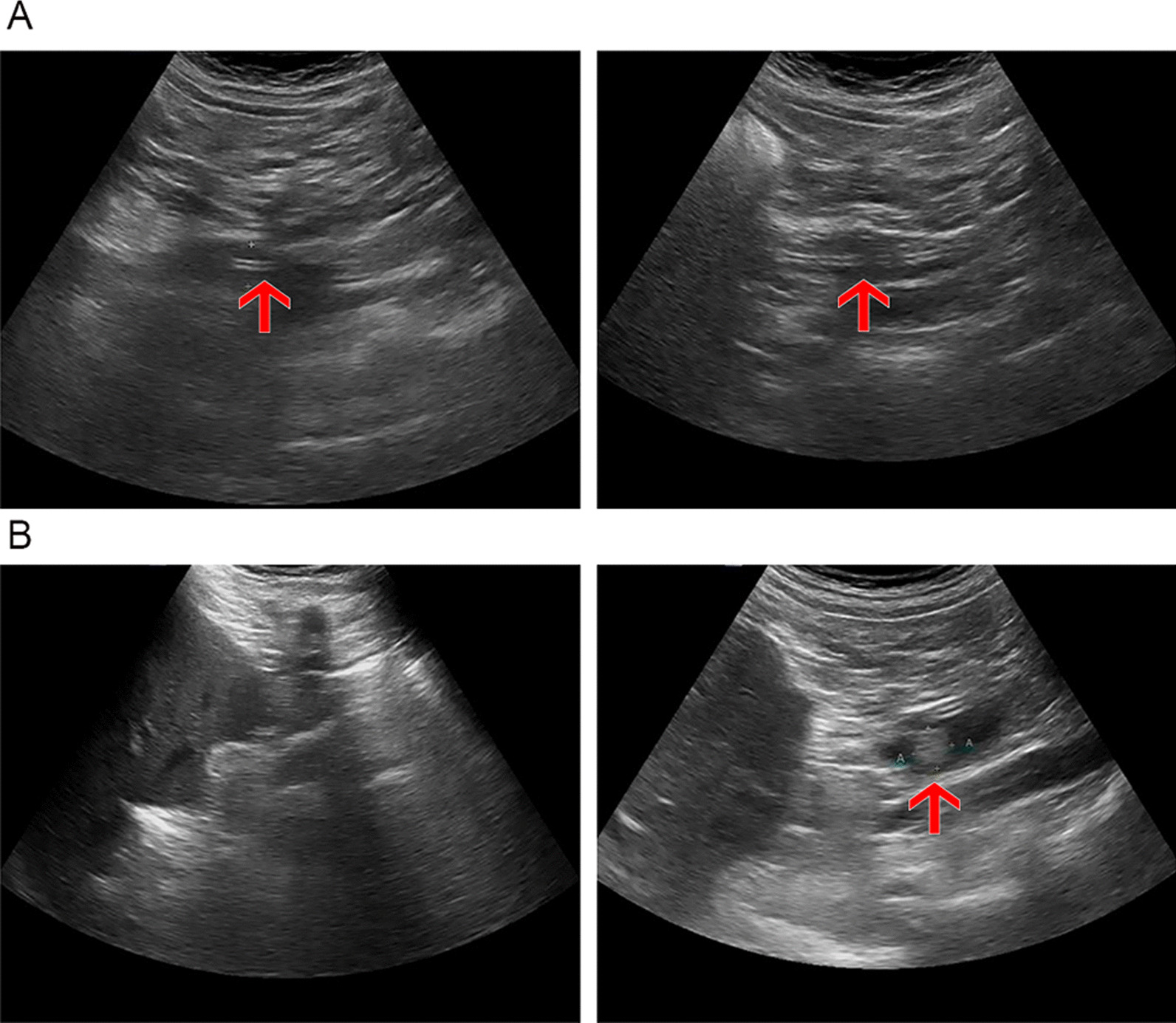Comparison between routine ultrasound and ENBD saline injection ultrasound in a 78-year-old women. A. The imaging length of CBD in ENBD saline injection ultrasound (right) is significantly longer than in routine ultrasound (left). B. Remnant stone in ENBD saline injection ultrasound found (right) that cannot be found in routine ultrasound (left)