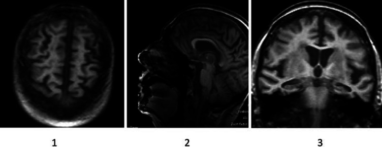 Simple brain MRI of the patient with CBD. 1 Superior vision of the cerebral hemispheres, a decrease in cerebral tissue and/or a volumetric reduction associated with cortical atrophy due to the widening of cerebral grooves is observed, frontal and parietal affectation is identified. 2 Middle sagittal section where involutive changes are observed in cerebral grooves associated to severe subcortical atrophy, especially in frontal region, marginal callosal fissure, paracentral lobe and parieto-occipital fissure. 3 Coronal section at the level of the hippocampus. Greater affectation is identified at a temporal level, clinically correlated with grade III hippocampal atrophy. Severe subcortical cortical atrophy continues.