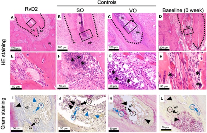 Histological analysis of periapical lesions after root canal treatment in rats. (A) Periapical area of treatment group stained with HE. (B,C) Periapical area of control groups stained with HE. (D) Periapical area of baseline group stained with HE. (E,F,G,H). High magnification views of the solid inset in (A–D), respectively. (I–L). High magnification views of the solid insets in (A–D), stained with a modified Brown and Brenn method. Images are representative for 5 experiments from Group #1 (RvD2 and SO); 3 experiments from Group #2 (VO), and 2 experiments Group #3 (baseline). RC, root canal; CA, closed apex; OA, open apex; AF, apical foramen. The asterisk denotes inflammatory cells and the black arrows specifying some of Gram negative bacteria stain red color and blue arrow specifying some of blue/purple stain Gram positive bacterial cells in canals. Outlined circular images with blue and black colors are higher magnification of specified areas coming from colored dotted circles corresponds to the identifications of Gram positive and negative bacteria.