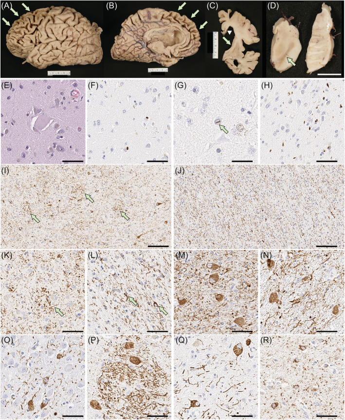 Pathologic findings of case 2. (A–D) Macroscopic finding reveals severe cortical atrophy over the frontal lobe (arrows in A and B), thinning of the corpus callosum (arrowhead in C) and massive enlargement of the lateral ventricles, especially the frontal horn (C). Basal ganglia show severe atrophy of the caudate nucleus with a concave ventricular surface (arrow in C) and attenuation of the anterior limb of the internal capsule. The substantia nigra shows marked loss of pigment (arrow in D). Balloon neurons are observed in the superior frontal gyrus on H&E‐stained sections (E). Immunohistochemistry for pTDP‐43 shows neuronal cytoplasmic inclusions (F), dystrophic neurites and neuronal intranuclear inclusions (G) in the superficial layer of the superior frontal cortex, consistent with FTLD‐TDP type A. (H) The amygdala has neuronal cytoplasmic inclusions and dystrophic neurites. Immunohistochemistry for CP13 shows astrocytic plaques and numerous threads in the grey matter of the superior frontal gyrus (I, K). Numerous threads and coiled bodies are observed in the adjacent white matter (J, L). Abundant pretangles with threads are present in the subthalamic nucleus (M), red nucleus (N), pontine base (O), inferior olivary nucleus (P) and dentate nucleus (Q). Argyrophilic grains and pretangles are observed in the cingulate gyrus (R). Scale bars: 1 cm in D; 50 μm in E, G, H and L–S; 25 μm in F; 100 μm in I and J