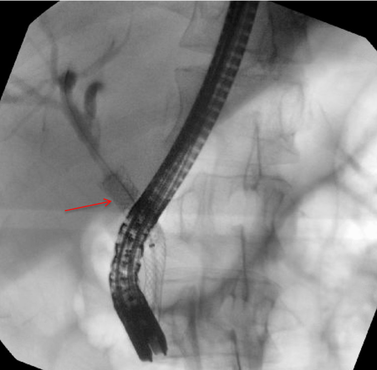 Fluoroscopic view of post-ERCP placement of a fully covered flexible metal biliary stent (red arrow) with good biliary drainage observed.Compared to the pre-procedure MRCP with a relatively low cystic duct junction, the proximal stent flange has occluded the level of the cystic duct junction.ERCP: endoscopic retrograde cholangiopancreatography; MRCP: magnetic resonance cholangiopancreatography