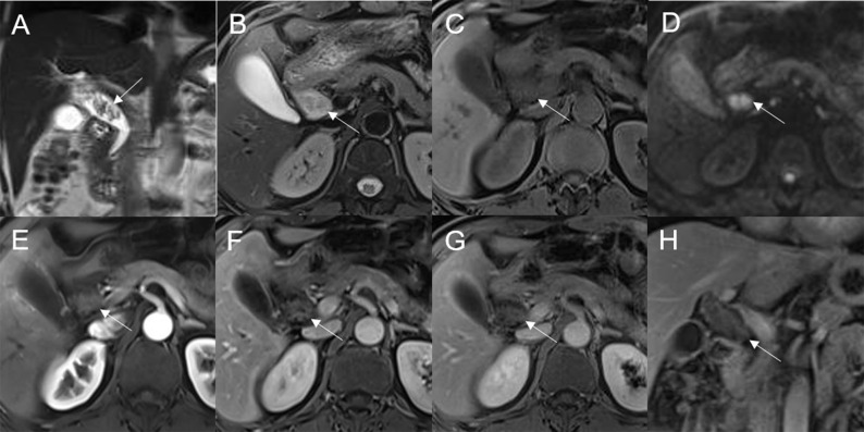 Adenoma in the common bile duct. The eccentric mass (white arrow) with a frond-like superficial appearance shows hyperintensity on T2WI (A, B), hypointensity on T1WI (C), and hyperintensity on DWI (D). The bile duct upstream of the lesion and at the lesion is dilated on coronal T2WI (A). The T1-postcontrast arterial phase (E), T1-postcontrast portal phase (F), and T1-postcontrast delayed phase (G, H) all show slight enhancement.