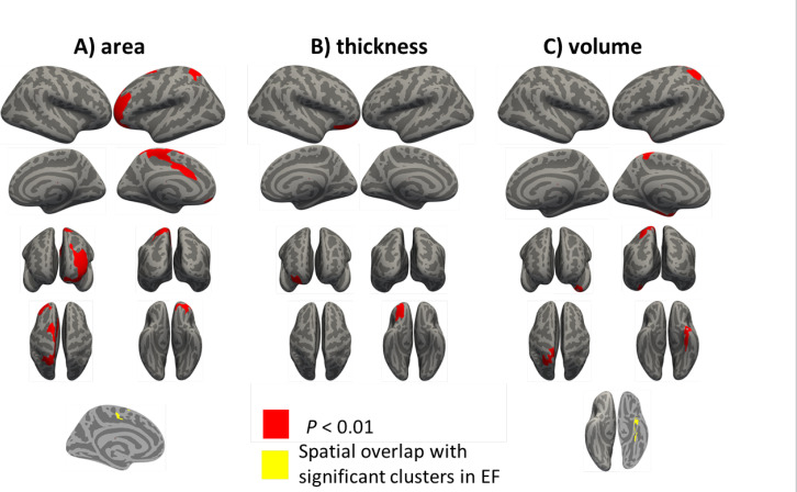 Group-level analysis of cortical measurementsA) Surface area, B) Thickness, C) Cortical volume based on a general linear model analysis in FreesurferNotes: The results from whole-brain vertex-wise analysis of cortical measurements between cannabis users (CB group) compared with healthy controls (HC group). All of the results are related to HC>CB contrast. Statistical maps are depicted on the inflated surface to allow visualization of sulci (dark gray) and gyri (light gray). Regions that remained significant following a cluster-based multiple comparison correction procedure are depicted (cluster-wise threshold, P<0.05). The lower row is related to the spatial overlap of regions demonstrating significant differences in EFs (illustrated in Figure 3) and significant differences in D) Surface area and E) Cortical volume among the CB group compared with HCNo spatial overlap was found between significant clusters in electric fields and cortical thickness