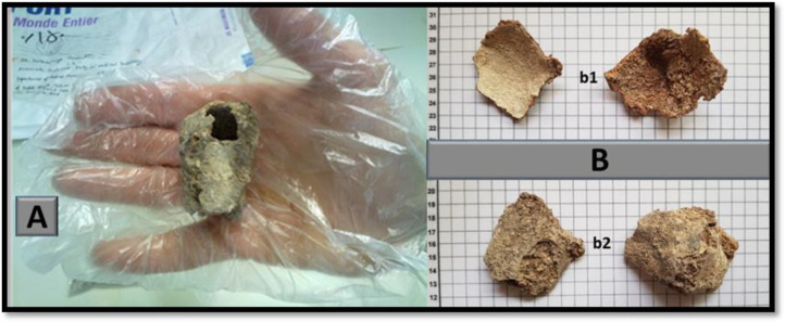 The calcified object identified as hydatid cyst (A, one of the recovered cysts, B, Represents the inner concave surface and the outer convex surface of that cyst)