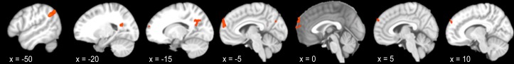 Areas showing significant between-subject (group) effect in PCC connectivity.Results from voxel-level ANCOVA analysis.