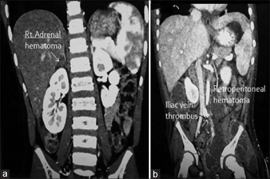 CECT abdomen showing (a) right adrenal haematoma (b) iliac vein thrombus with retroperitoneal haematoma, CECT: Contrast-enhanced computed tomography