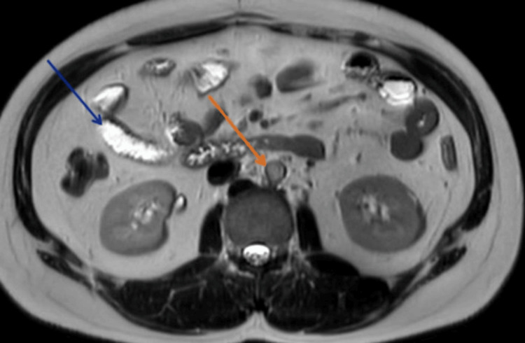 Magnetic resonance cholangiopancreatographyAn axial T2-weighted MR image shows a conglomerate of necrotic lymph nodes (orange arrow) in the portacaval region, just posterior to the pancreatic head. This nodal mass is causing extrinsic compression and smooth tapering of the distal common bile duct (blue arrow), with resultant upstream biliary dilatation. This appearance is classic for benign extrinsic compression, in this case from tuberculous lymphadenitis.