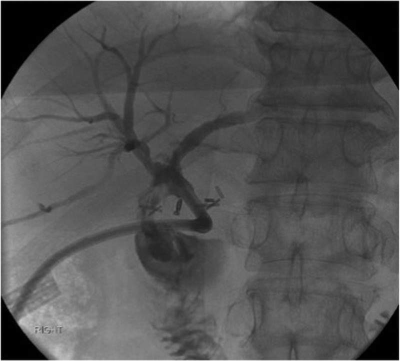 Cholangiogram through the external catheter demonstrating a fistula between the common bile duct, just below the confluence of the right and left hepatic ducts at the terminal end of the catheter, and the duodenum.