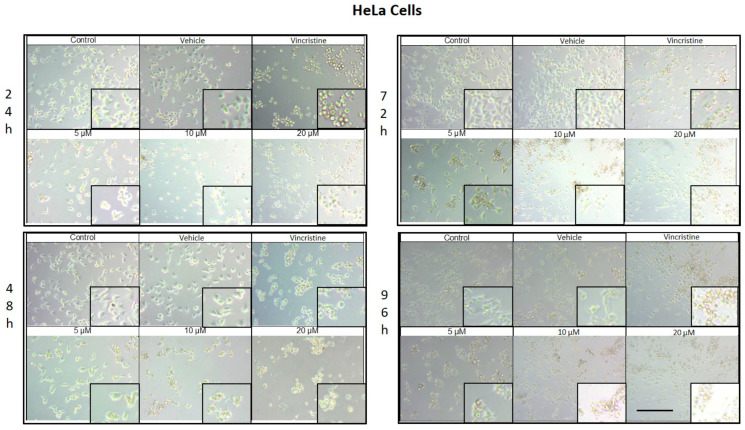 HeLa cells treated with CBD and controls for 24, 48, 72, and 96 h. Treatments included CBD at concentrations of 5, 10, and 20 μM, 1 μM vincristine, methanol (vehicle), and culture medium (control). Scale bar: 300 μm.