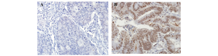 Examples of immunohistochemical staining of the cannabinoid type 1 (CB1) receptor in human colorectal cancer. Tumor cells exhibit low (A) and high (B) expression of the CB1 receptor. Original magnification, ×400.