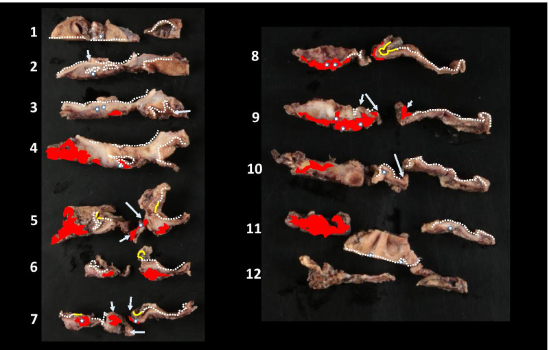 Sequential sections of resected specimen with serial number. White dotted lines indicate non-tumoral epithelium. The CIS (yellow lines) and the hemorrhage sites (red areas) including the ulceration sites (white arrow) are distant. Embolic material (white spot) is observed in the hemorrhage site, and an ulcer and superficial vascular aggregates are observed at the sites irrelevant to the CIS