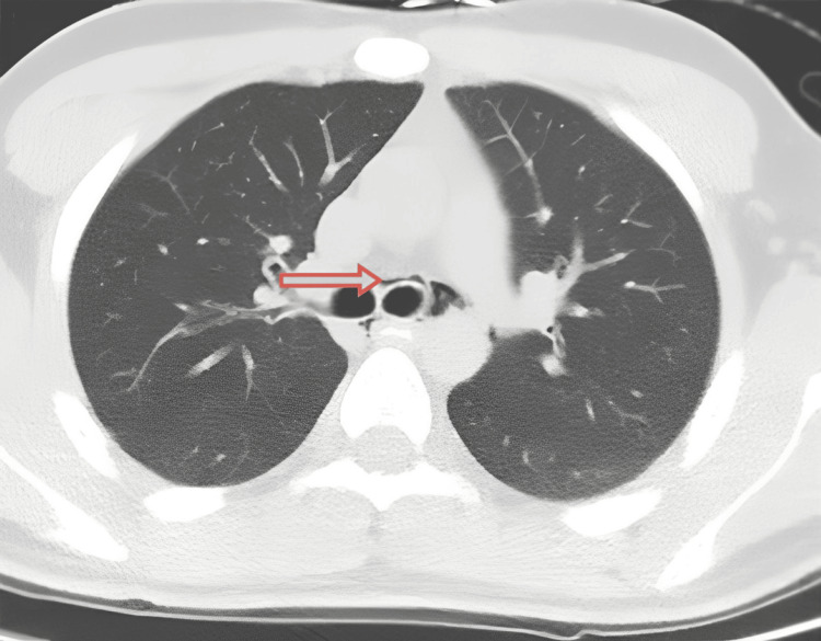 Axial CT image demonstrating pneumomediastinumA thin rim of air (arrow) is visible adjacent to the trachea (the round black airway in the center), dissecting the normally gray-white mediastinal tissue.