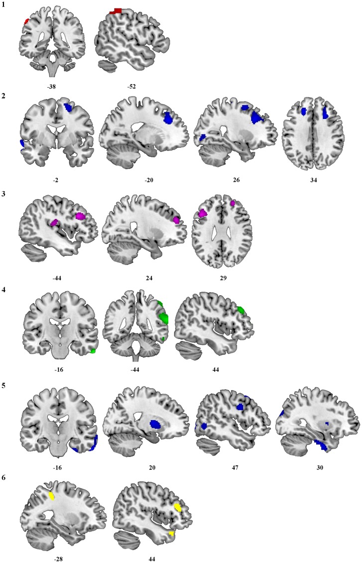 Areas of reduced metabolism predicted by the amount or duration of drug use:(1) amount of cocaine, (2) amount of alcohol, (3) amount of cannabis (4) duration of heroin (5) duration of alcohol and (6) duration of MDMA. Areas of reduced metabolism are superimposed on a T1 weighted MRI image in MRICRON. MNI coordinates are shown underneath each panel.