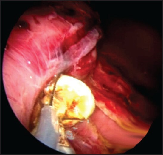 Stones found were basketted out with ERCP basket passed through the scope