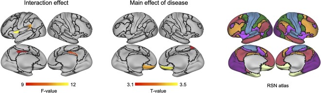 The interaction and main effect in the FDG1. (left) The interaction effect between the schizophrenia (disease factor) and nicotine (smoking factor) is rendered on the 3-D brain (P < 0.05 corrected); (middle) the main effect of the schizophrenia (disease factor) is rendered (P < 0.05 corrected); the counterlines are according to the Yeo-atlas (right).