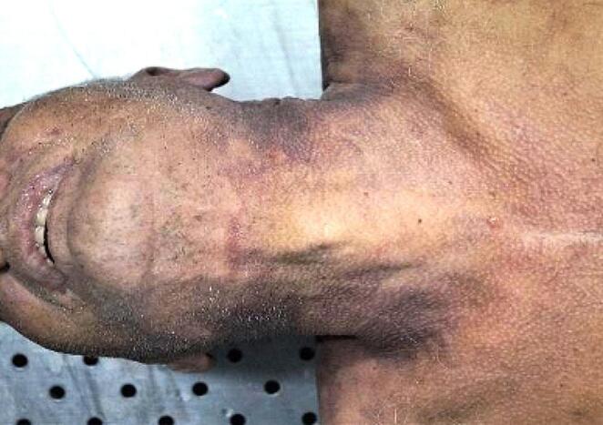 Anterior cervical region with incomplete furrow and faint reddish discolored skin