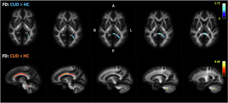 Fixel-Based Analysis: individuals with CUD displayed increased FD in the splenium of the corpus callosum (shown in blue-dark blue, starting slice number 15 with 2 mm increment), and reduced FD within the bilateral cingulum and right cerebellum compared to healthy non-users (shown in yellow-red, starting slice number 36 with 2 mm increment). Scale reflects test statistic values across significant voxels (FWE-corrected, p < 0.05).