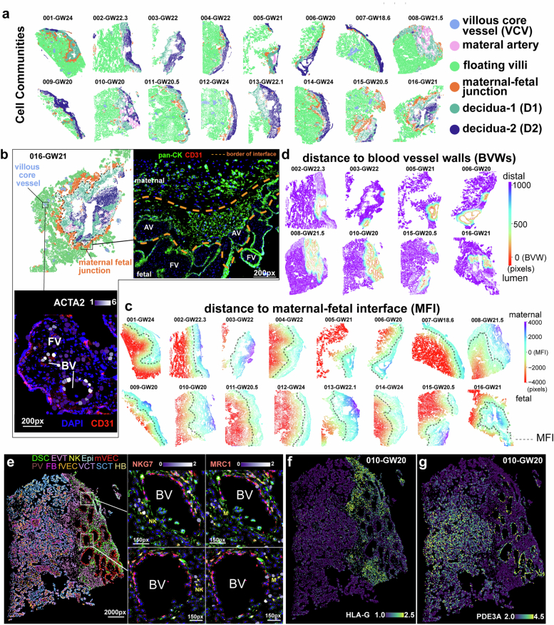 Spatial mapping of cell types.(a) Six cell communities identified across 16 samples, with regions annotated as villous core vessels (VCV), maternal artery, floating villi (FV), maternal-fetal junction (Junction), decidua-1 (D1), and decidua-2 (D2). (b) Zoomed views of a VCV niche (bottom; ACTA2+ perivascular cells) and a junction niche (right) at GW21, immunostained for pan-CK (green) and CD31 (red); interface boundary=orange dashed line. AV, anchoring villi; BV, blood vessel. (c) Spatial map of distance to the maternal-fetal interface across 16 samples (positive, maternal; negative, fetal). (d) Spatial map of distance to maternal spiral artery vessel walls (BVWs) across 8 samples with detectable uterine vessels. Positive values, extraluminal; negative values, intraluminal. (e) Spatial views (GW20 basal plate) showing immune cells adjacent to a BV. Arrows indicate NK cells (NKG7) and macrophages (CD14). (f-g) Spatial maps showing aggregation of HLA-G+ EVTs (f) around PDE3A+ spiral arteries (g) undergoing active remodeling.