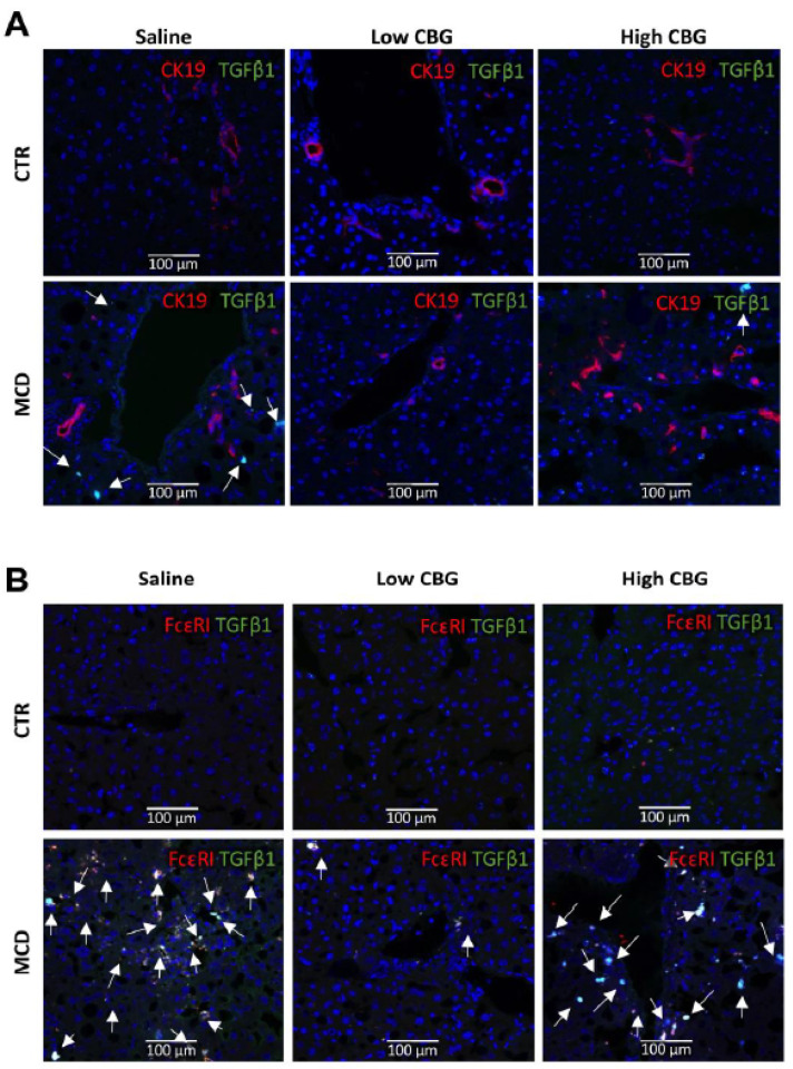 Colocalization of the proinflammatory marker TGF-β1 with the cholangiocytes (CK19+) or mast cells (FcεR1+) in mice liver tissue. (A) Immunofluorescence co-staining of cholangiocytes biomarker CK19 (red) and proinflammatory factor TGF-β1 (green), and DAPI (nuclei stained in blue). CK19+ cells were not co-localized with TGF-β1 (white arrows). (B) immunofluorescence co-staining of mast cell biomarker FcεR1 (red) and proinflammatory factor TGF-β1 (green), and nuclei (blue). Strong colocalization of TGF-β1 with mast cells in MCD groups (white arrows). Pictures are taken at 20× magnification.